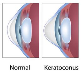 Eye with keratoconus