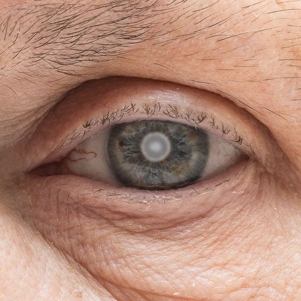 Closeup of eye clouded by cataract